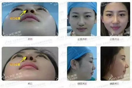 隆鼻手術(shù)切口在哪里？才能自然不留疤