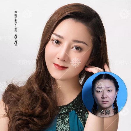 沒(méi)有騙你！雙眼皮手術(shù)輕松就能夠解決七大問(wèn)題
