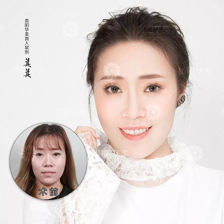 兩針玻尿酸擁有側(cè)顏殺，90%的仙女都缺它！