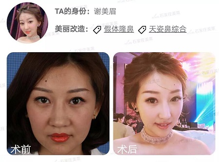 做了假體隆鼻后，變化有多大！看4個(gè)案例對比
