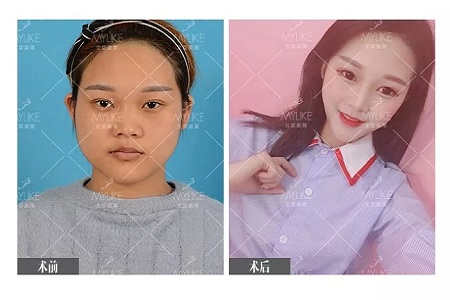 顏值：鼻子的改變能讓一個(gè)女孩變化有多大？