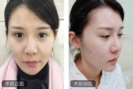 顏值：做完自體脂肪填充15天后，她變啥樣了？