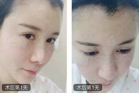 顏值：做完自體脂肪填充15天后，她變啥樣了？