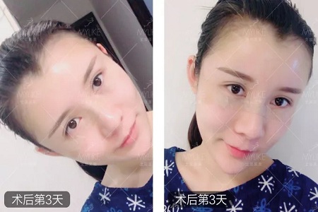 顏值：做完自體脂肪填充15天后，她變啥樣了？