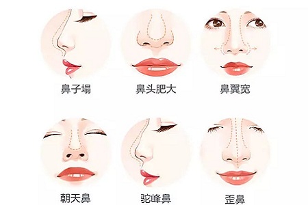 什么，隆鼻方式竟然有這么多種？