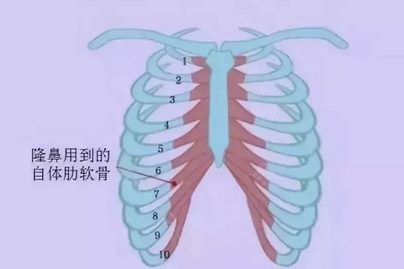 什么，隆鼻方式竟然有這么多種？
