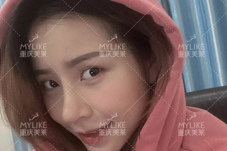 糾結(jié)！鼻頭太圓想塑形是用肋軟骨還是耳軟骨好？
