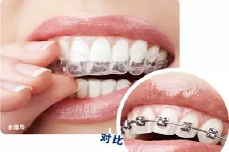 新品：整牙=換臉？隱適美IGO實(shí)現(xiàn)所有不可能！