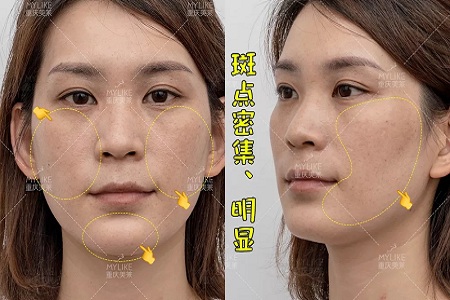 那個(gè)斑點(diǎn)女孩后來(lái)怎么樣了？