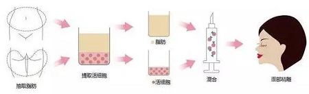 明星的臉和你的臉差的只是這一步！--面部脂肪填充