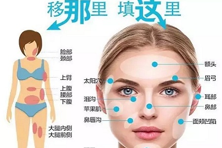 明星的臉和你的臉差的只是這一步！--面部脂肪填充