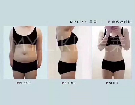 吸脂減肥