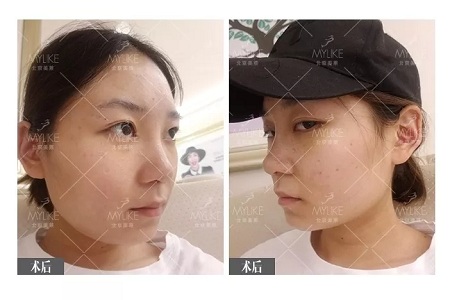 顏值：插座鼻變小翹鼻，就是這么神奇！