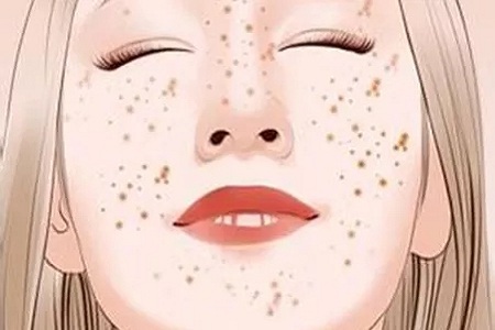 問診室：祛斑不難，找對病因才是重點，祛斑較全面科普看過來