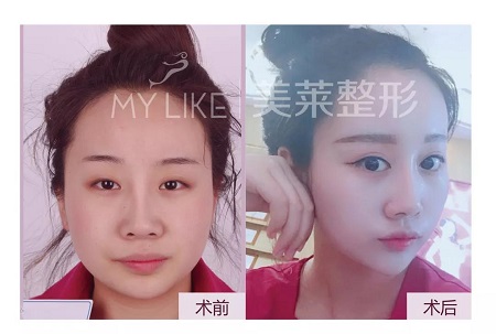 雙眼皮