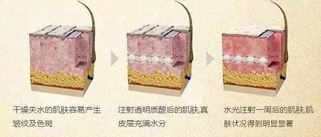 水光，打1次和4次究竟有多大區(qū)別？