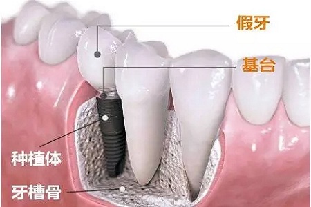 美萊牙齒矯正，讓你吃的香吃的好重享美味