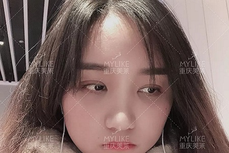 自體脂肪+雙眼皮，這對cp你不pick一下嗎？