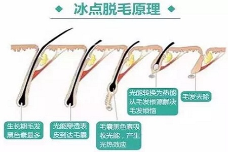 既便宜又安全的脫毛方法是什么？