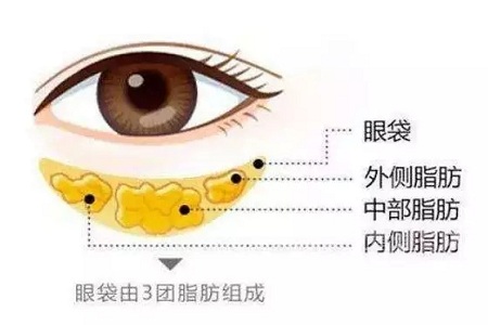 去掉眼袋，刻不容緩，別等又大又松弛才做