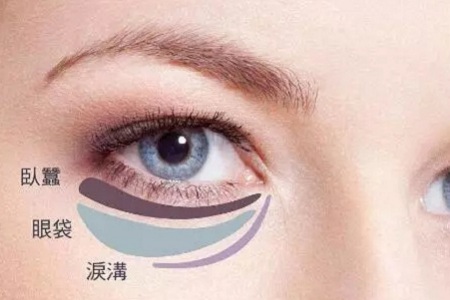 去掉眼袋，刻不容緩，別等又大又松弛才做