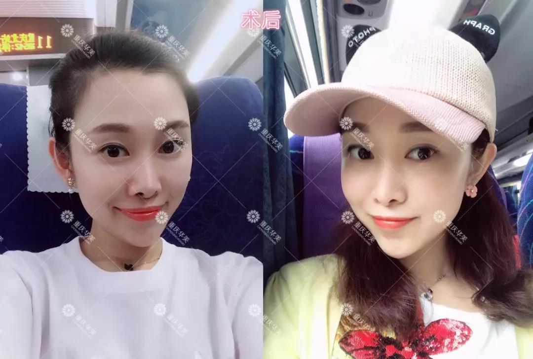 路人臉變上鏡臉，玻尿酸打一次真的會(huì)變美