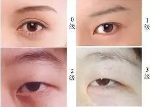 美萊實驗室：開眼角就是醫(yī)師想多收錢？
