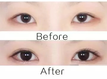 美萊實驗室：開眼角就是醫(yī)師想多收錢？