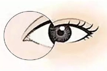 美萊實驗室：開眼角就是醫(yī)師想多收錢？