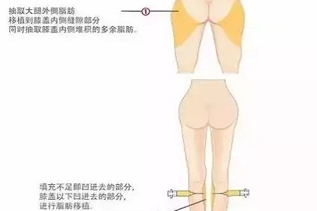 問診室：你說脂肪壓得你好累，殊不知它也可以是寶貝