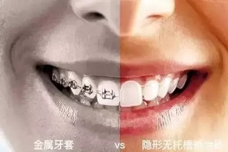 告別鋼牙妹——隱形矯正新時代，拯救尷尬的微笑！