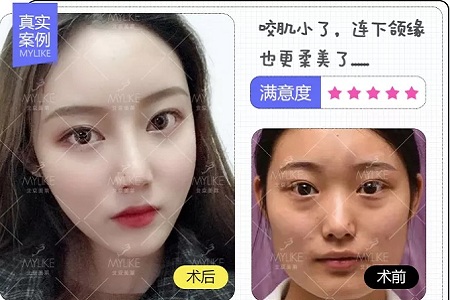 ?讓你擁有V臉、香肩、細腿的神器--玻尿酸的作用原理你真的知道嗎？