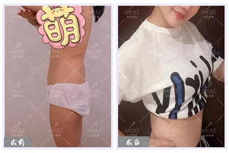 顏值：媽寶“水桶腰”變“水蛇腰”的方法--吸脂