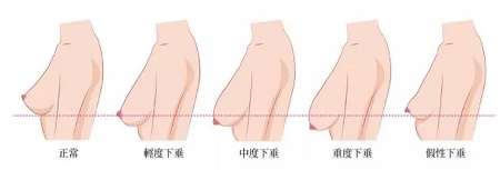 一味追求大胸的她們，卻忽略了這個問題...