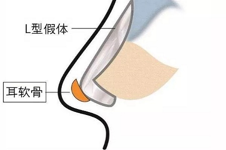 想知道身邊人有沒有做過隆鼻？看完這篇文章你就知道了