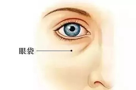 眼袋也分很多類型，看看你屬于哪一型？