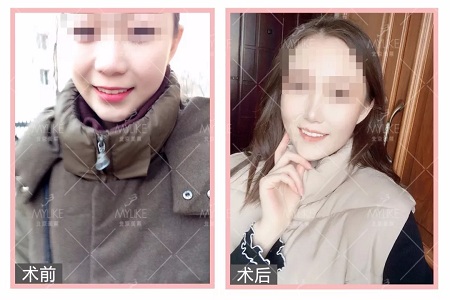 顏值日志 | 鼻子對(duì)整體顏值的改變有多大？