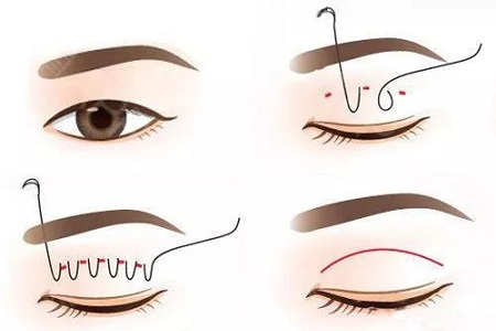 ?雙眼皮手術(shù)只聽過全切？還有哪些眼部手術(shù)方法？