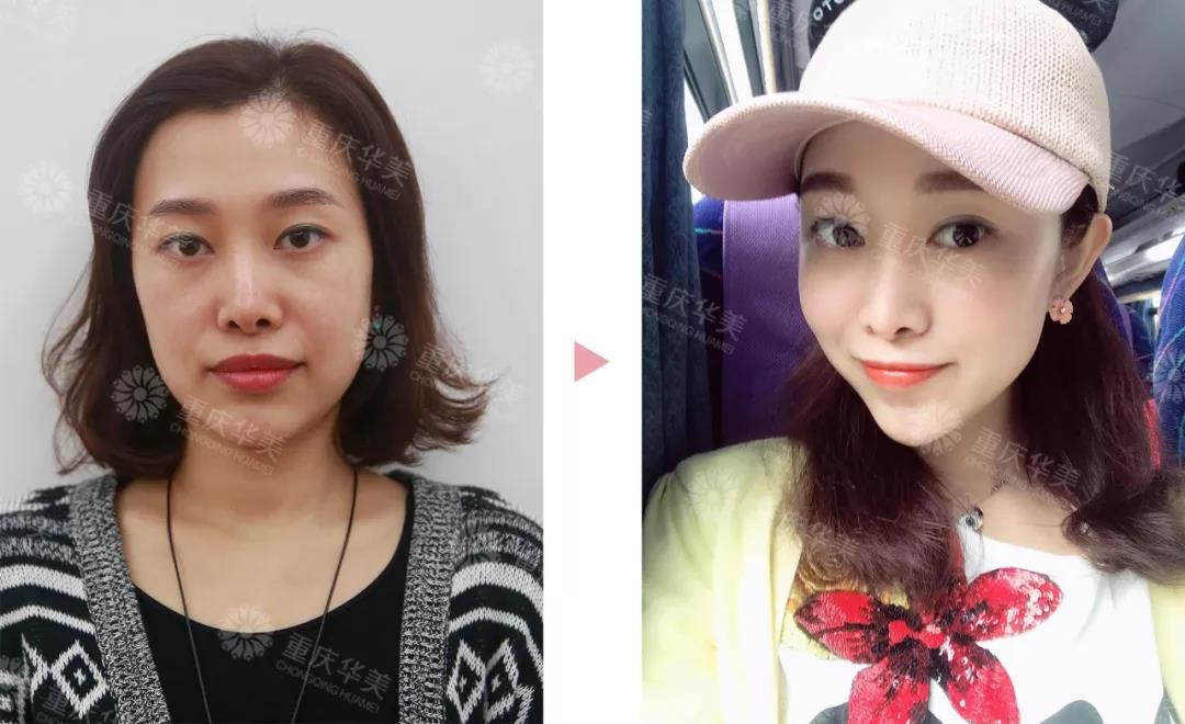 線雕做了一年后，臉會(huì)不會(huì)比以前垮？