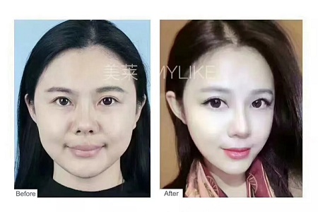 想抗衰，線雕和玻尿酸哪個更適合？