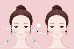 鄭州美萊整形打完瘦臉針有副作用嗎？