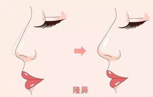 <a href='/zz/' target='_blank'><u>鄭州美萊</u></a>整形醫(yī)院隆鼻有幾種、效果怎么樣？
