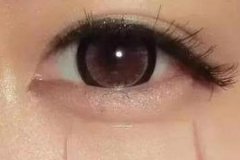 自體脂肪豐臥蠶填幾次有效果，術(shù)后注意事項有哪些