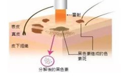 西安整形醫(yī)院做點(diǎn)陣激光多少錢，一次有效果嗎