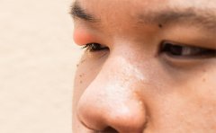 天生腫眼泡抽脂會(huì)反彈嗎，南京、杭州、上海眼皮抽脂費(fèi)用表