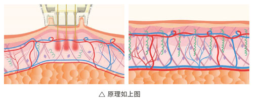 超光子+水光，“撐起”皮膚彈、潤、緊